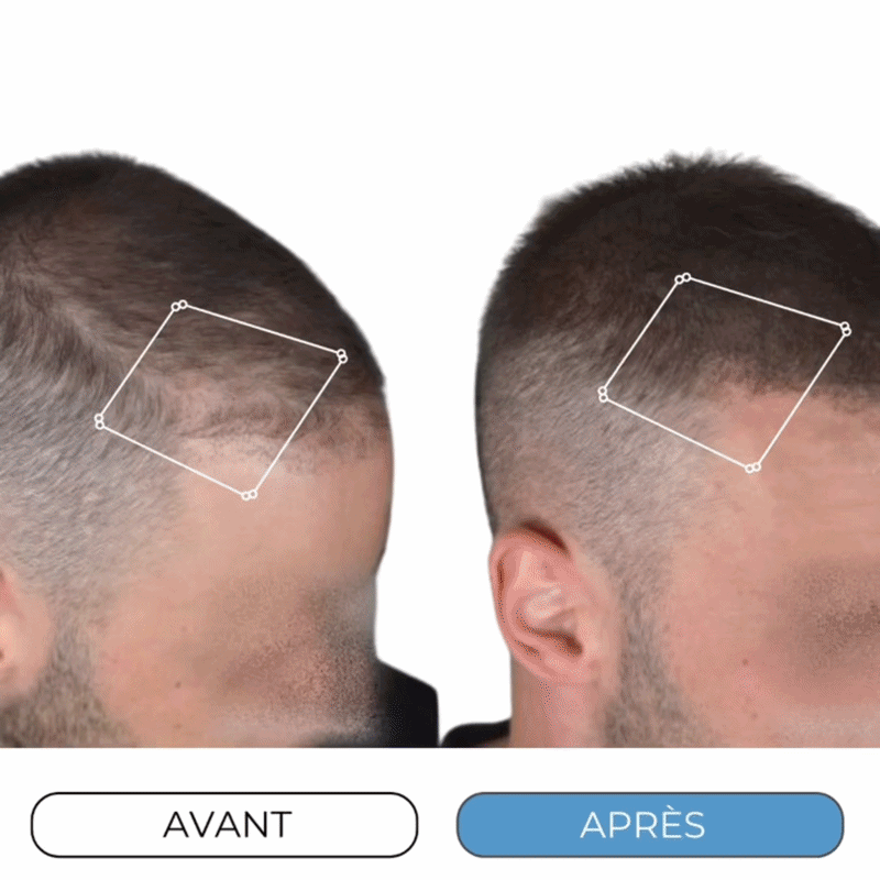 Rolivea™ Système de Réveil Folliculaire